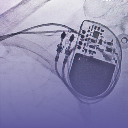 Pacemaker Implant Hospital Kolkata - Kothari Medical Centre