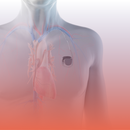 Pacemaker Operation Kolkata - Kothari Medica Centrel